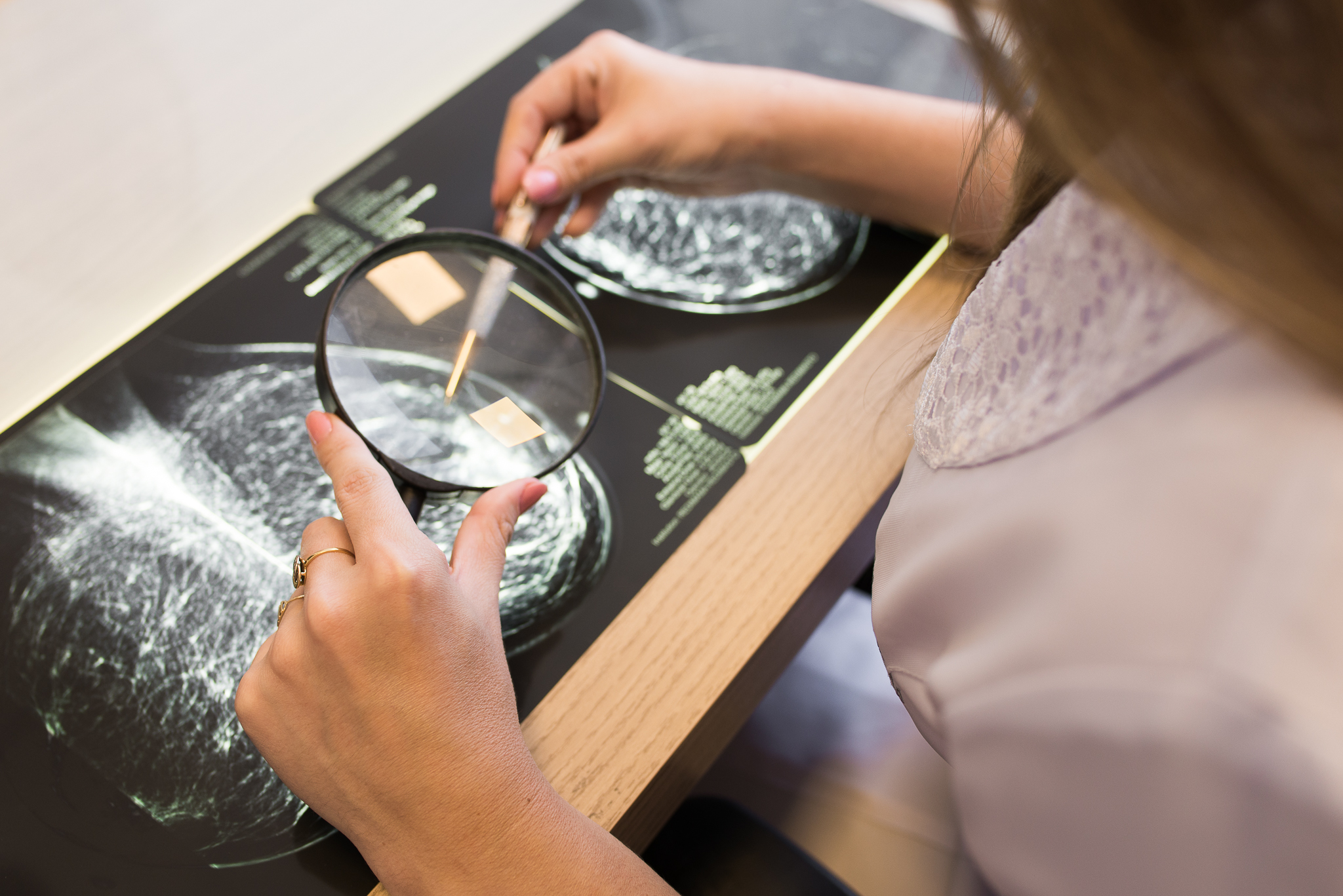 Mãos da mastologista analisam chapas de mamografia com lupa sobre o negatoscópio
